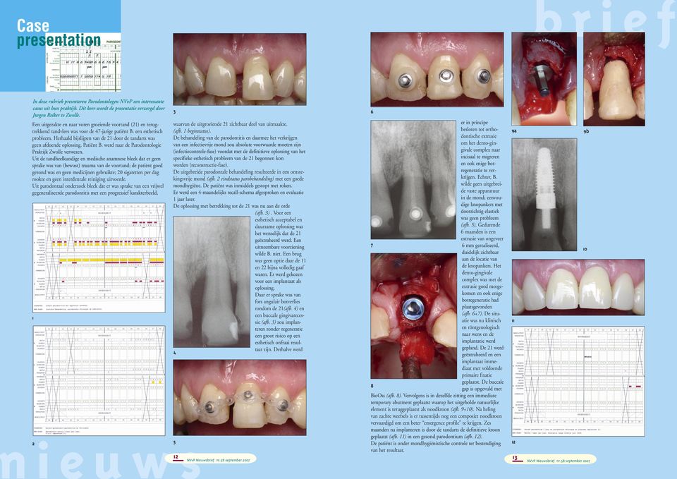 Herhaald bijslijpen van de 21 door de tandarts was geen afdoende oplossing. Patiënt B. werd naar de Parodontologie Praktijk Zwolle verwezen.