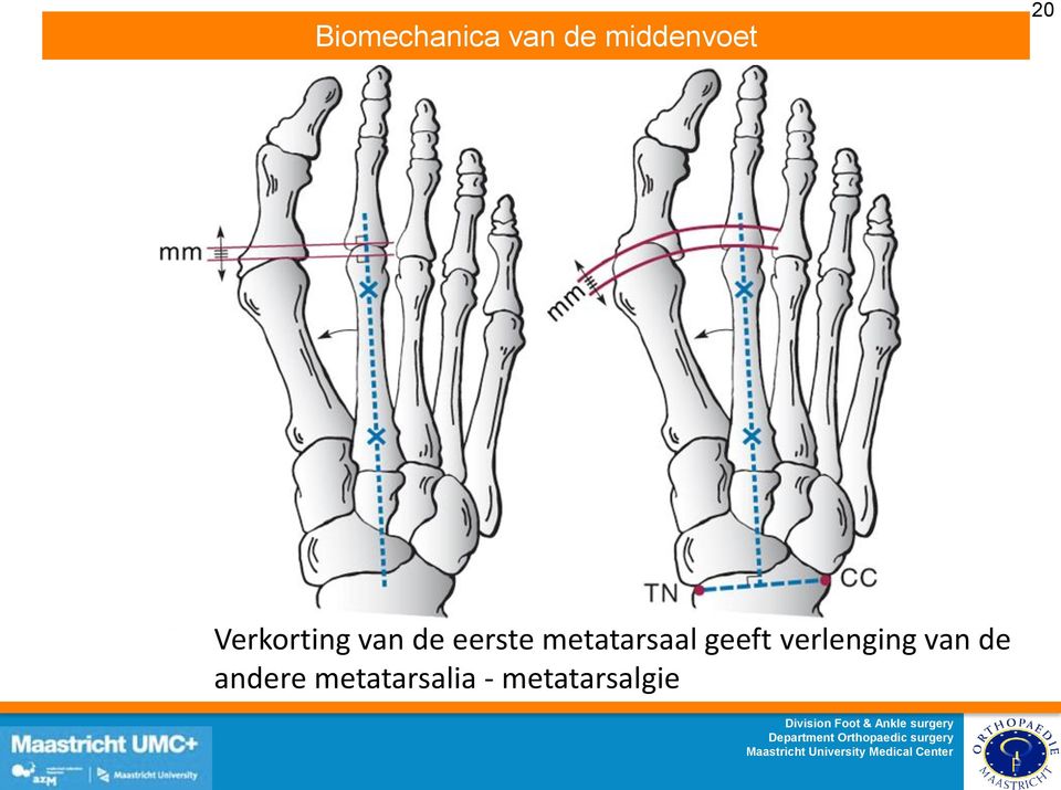 metatarsaal geeft verlenging van