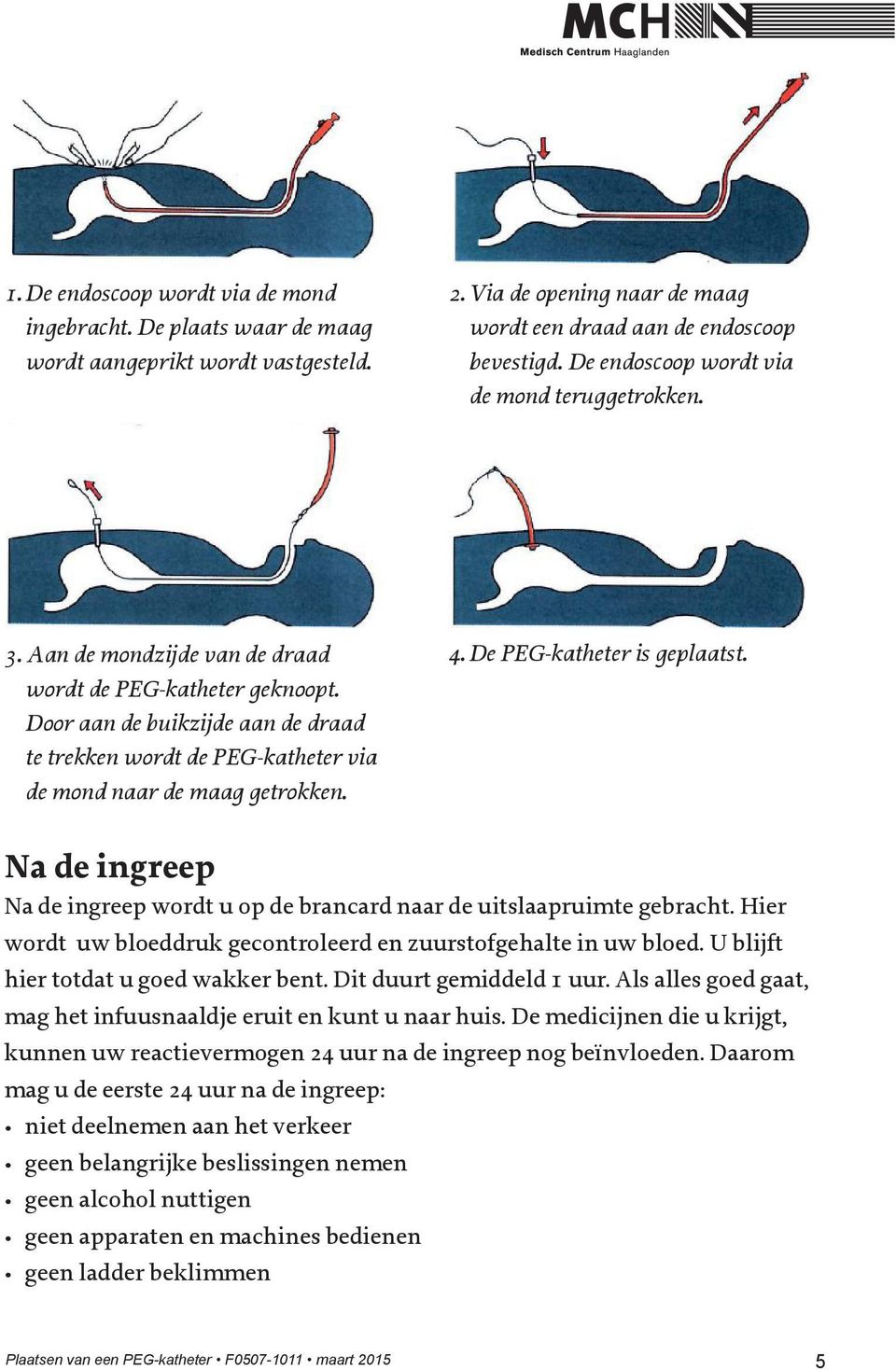Door aan de buikzijde aan de draad te trekken wordt de PEG-katheter via de mond naar de maag getrokken. 4. De PEG-katheter is geplaatst.