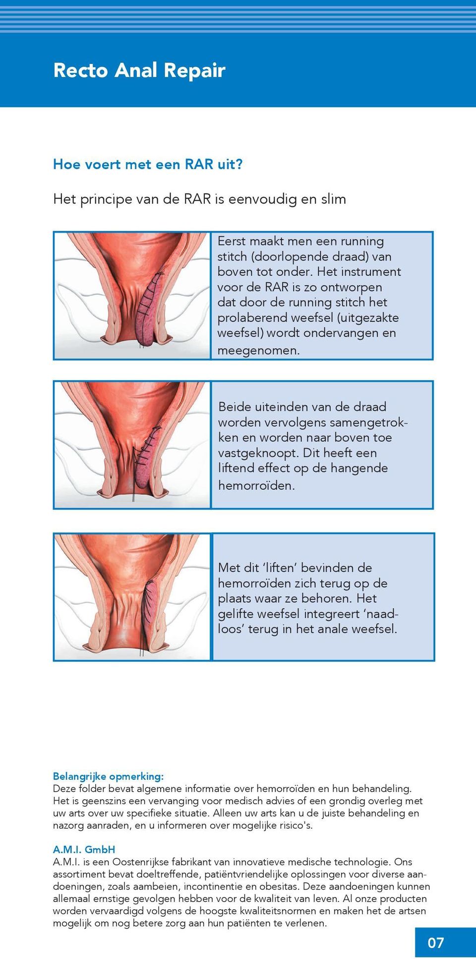 Beide uiteinden van de draad worden vervolgens samengetrokken en worden naar boven toe vastgeknoopt. Dit heeft een liftend effect op de hangende hemorroïden.