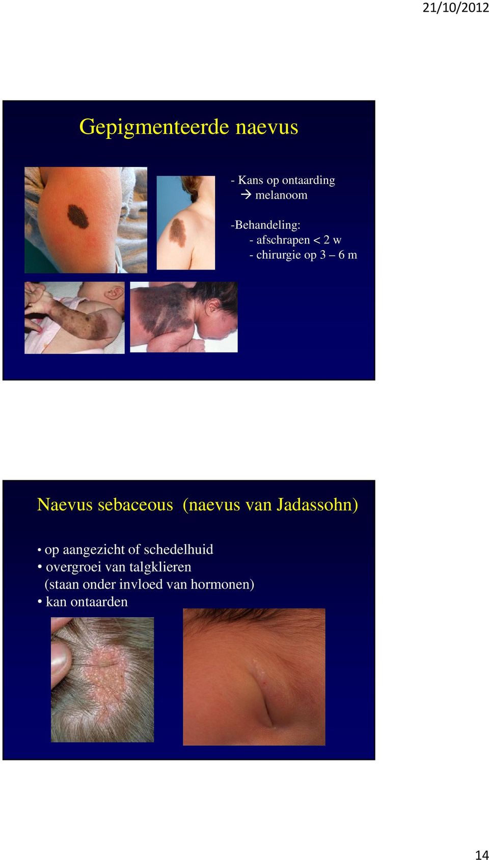 sebaceous (naevus van Jadassohn) op aangezicht of schedelhuid