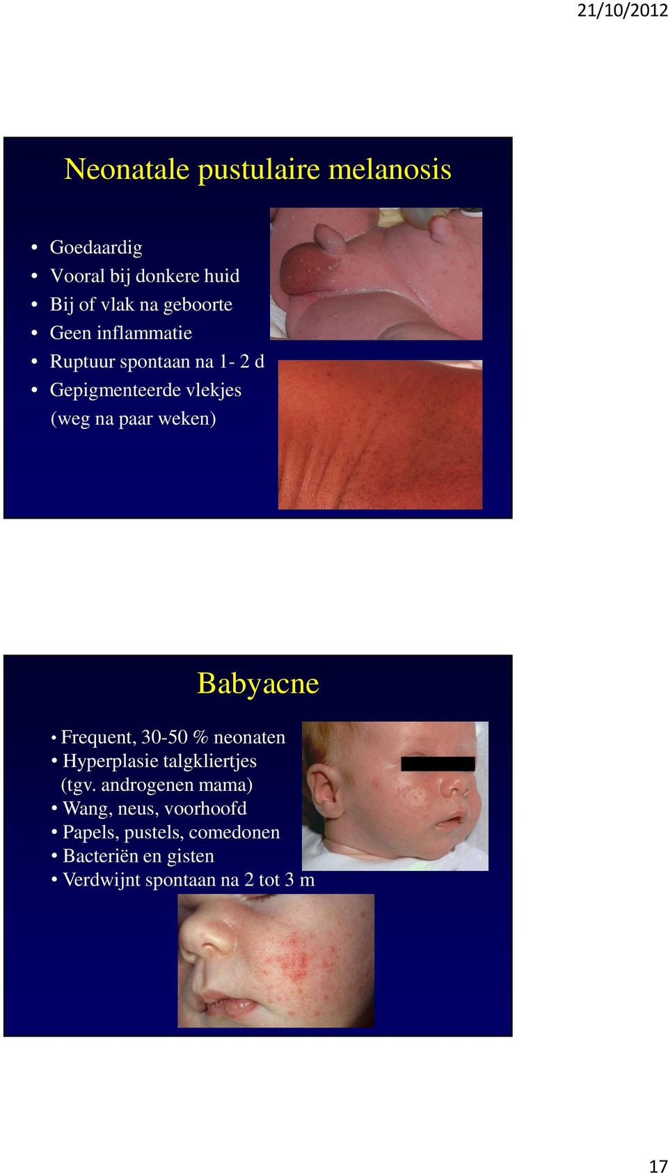 Babyacne Frequent, 30-50 % neonaten Hyperplasie talgkliertjes (tgv.