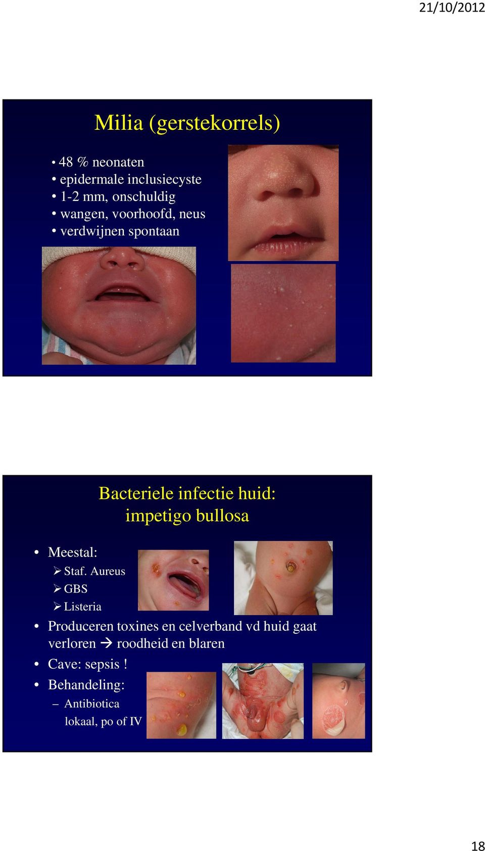 impetigo bullosa Staf.