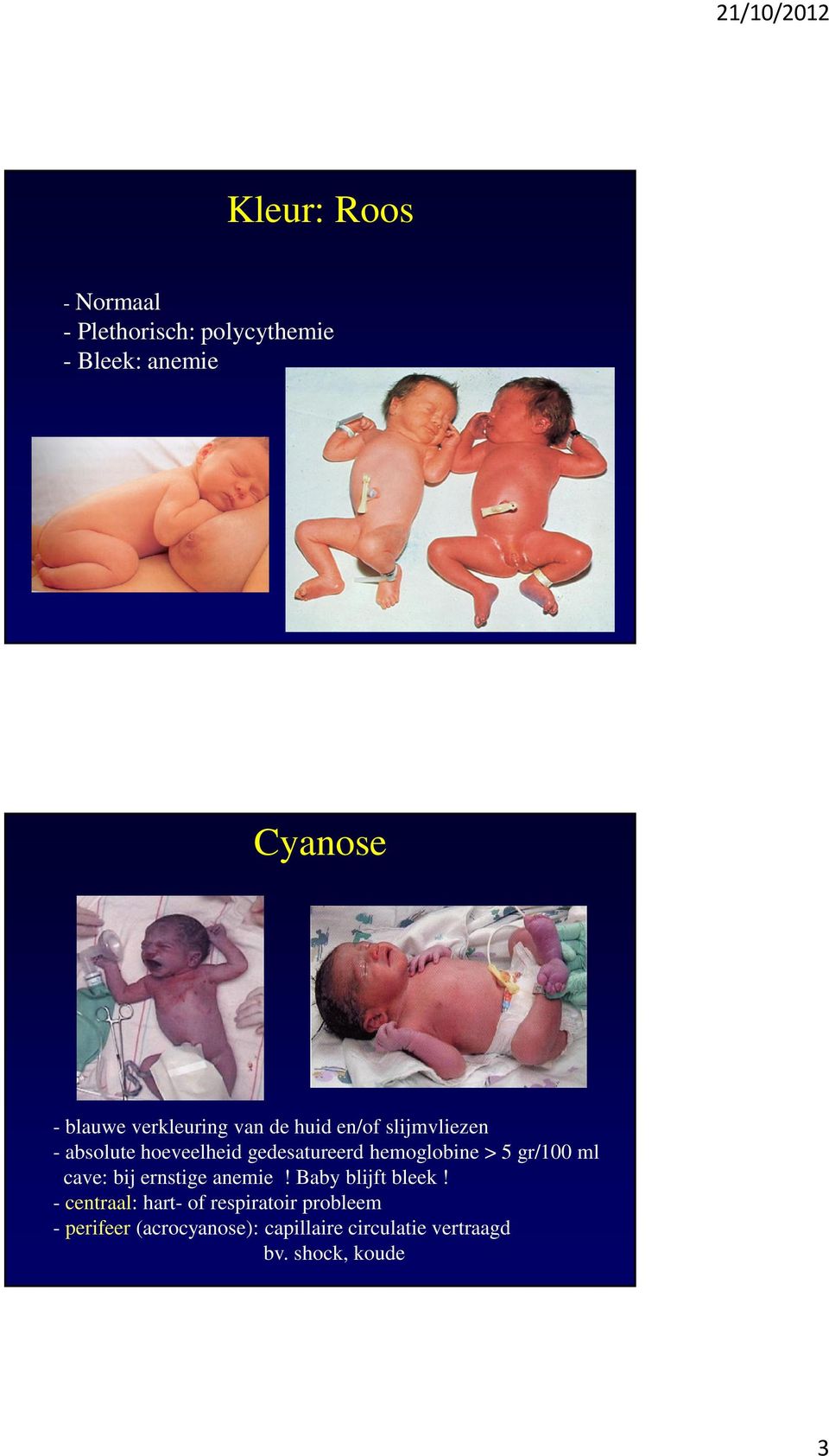 hemoglobine > 5 gr/100 ml cave: bij ernstige anemie! Baby blijft bleek!