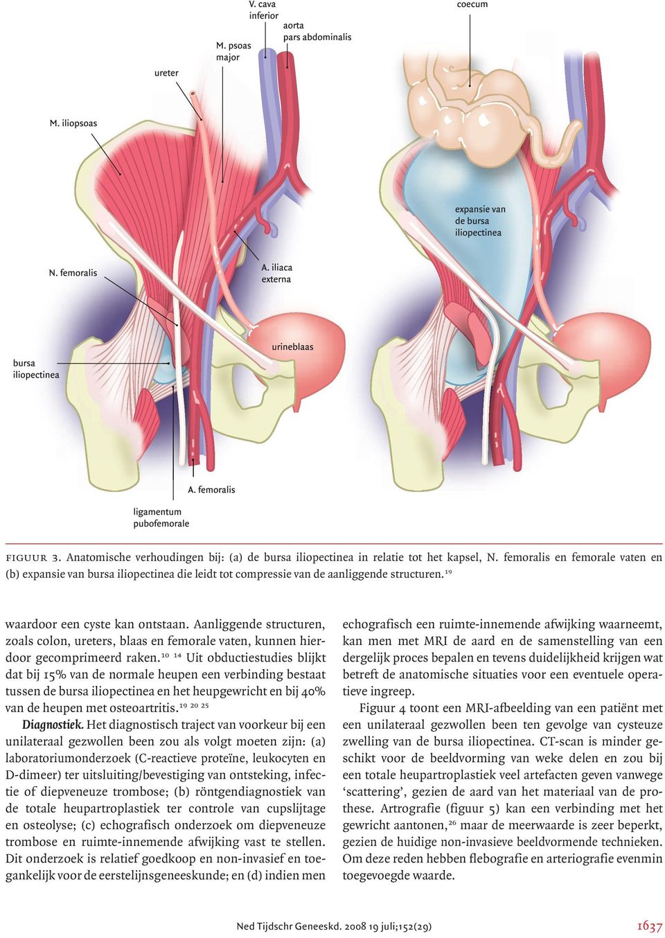 Aanliggende structuren, zoals colon, ureters, blaas en femorale vaten, kunnen hierdoor gecomprimeerd raken.