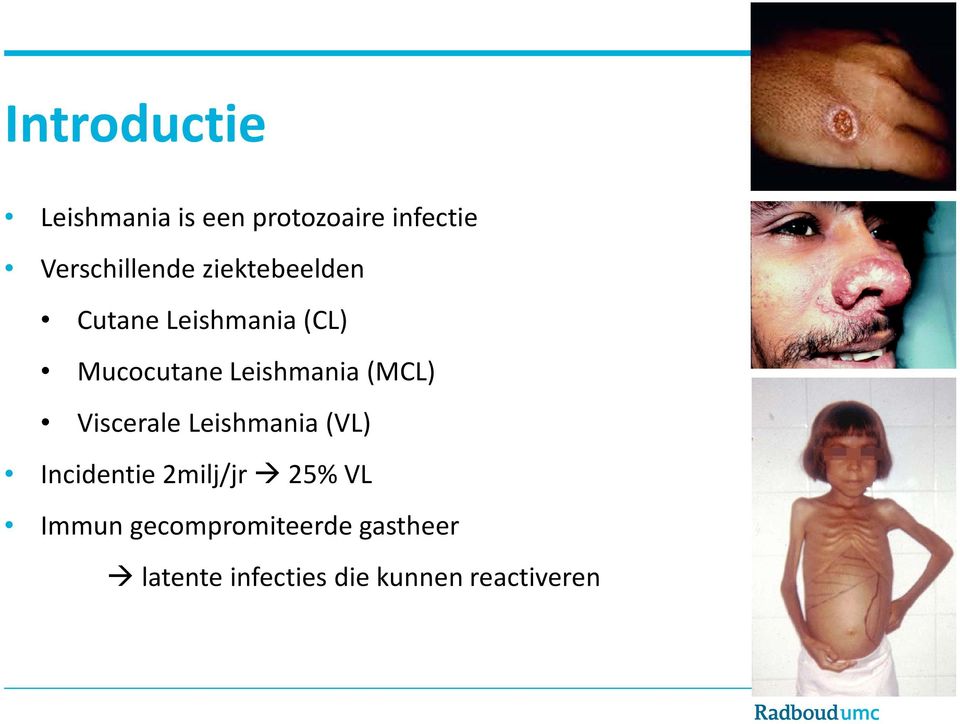 Leishmania (MCL) Viscerale Leishmania (VL) Incidentie 2milj/jr
