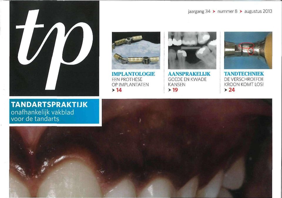 KANSEN >19 TANDTECHNIEK DEVERSCHROEFDE KROON KOMT LOS!