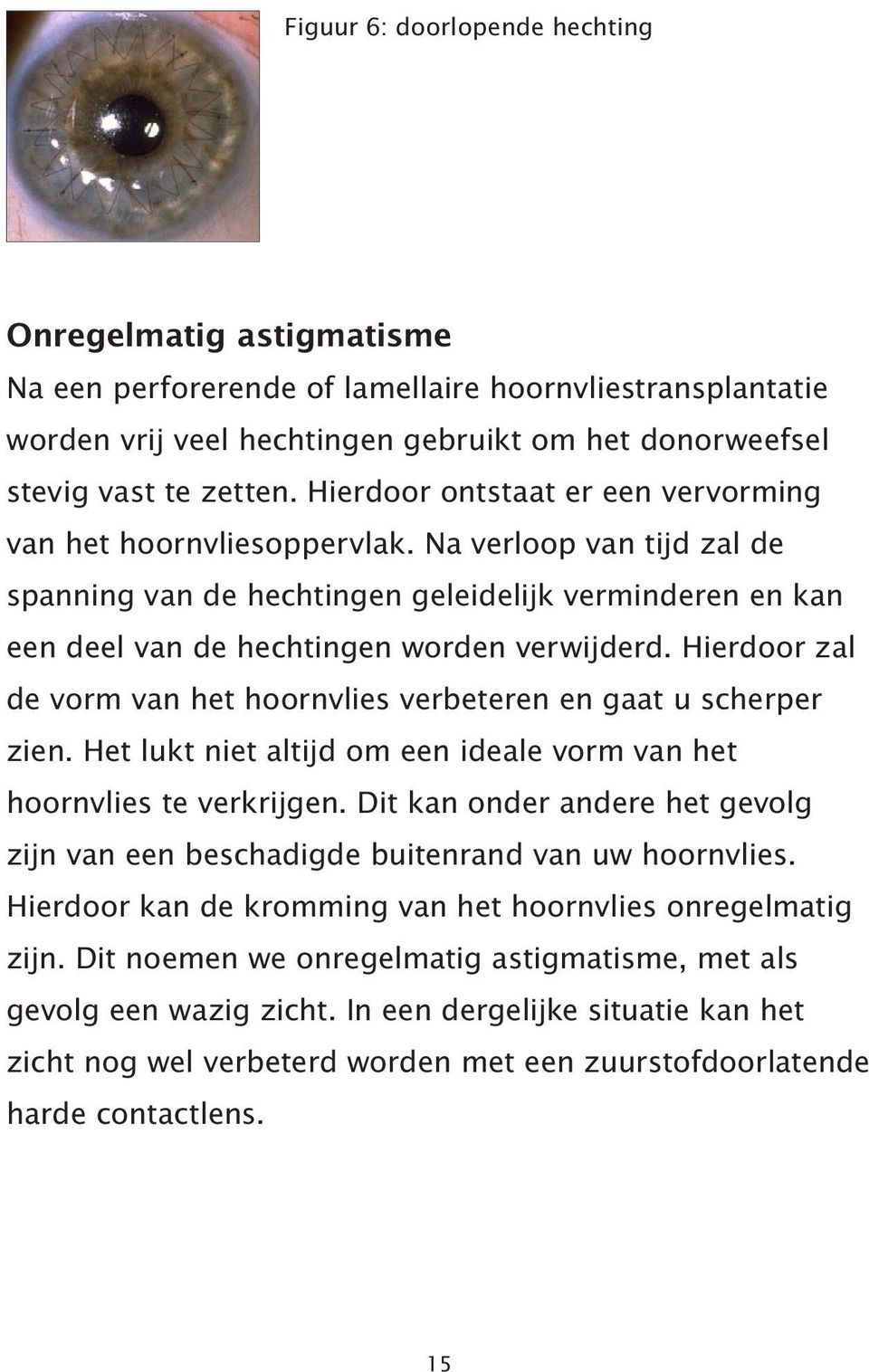 Hierdoor zal de vorm van het hoornvlies verbeteren en gaat u scherper zien. Het lukt niet altijd om een ideale vorm van het hoornvlies te verkrijgen.