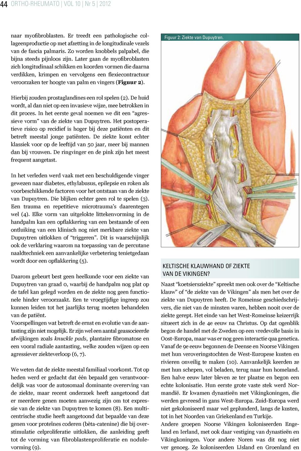 Later gaan de myofibroblasten zich longitudinaal schikken en koorden vormen die daarna verdikken, krimpen en vervolgens een flexiecontractuur veroorzaken ter hoogte van palm en vingers (Figuur 2).