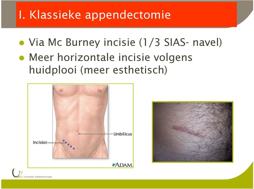 navel) Meer horizontale incisie