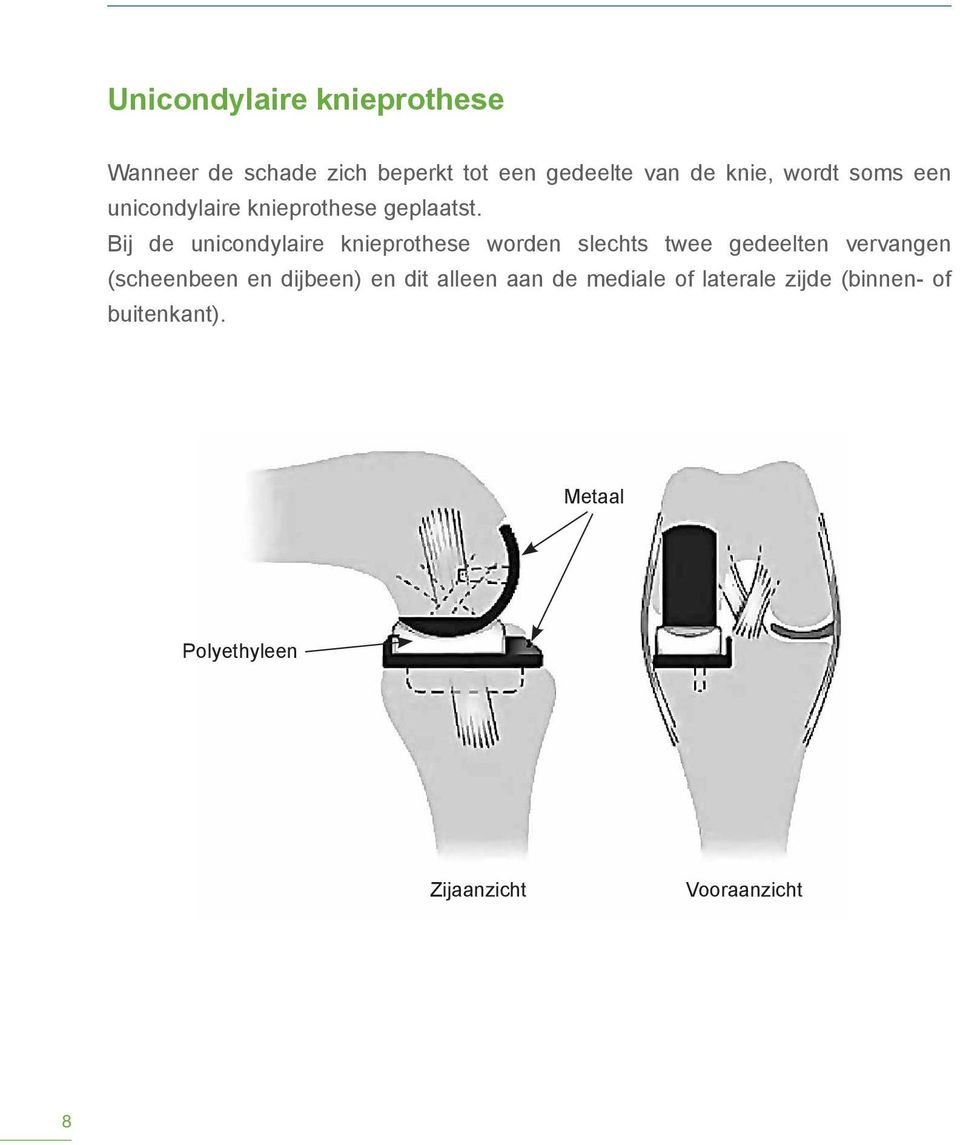 Bij de unicondylaire knieprothese worden slechts twee gedeelten vervangen (scheenbeen en