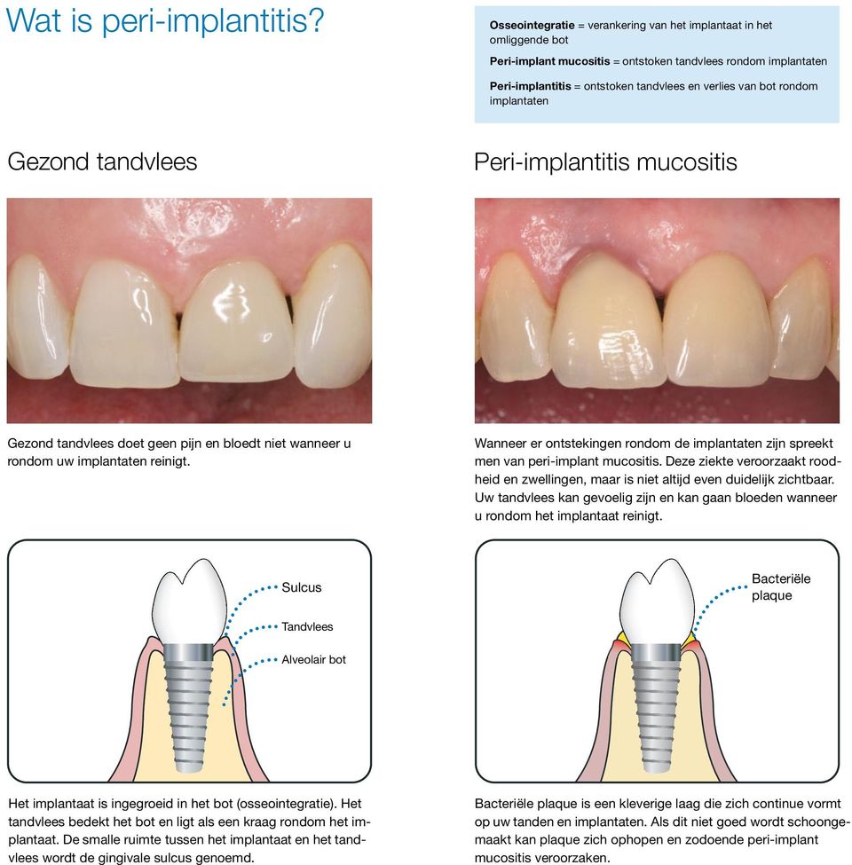 implantaten Gezond tandvlees Peri-implantitis mucositis Gezond tandvlees doet geen pijn en bloedt niet wanneer u rondom uw implantaten reinigt.