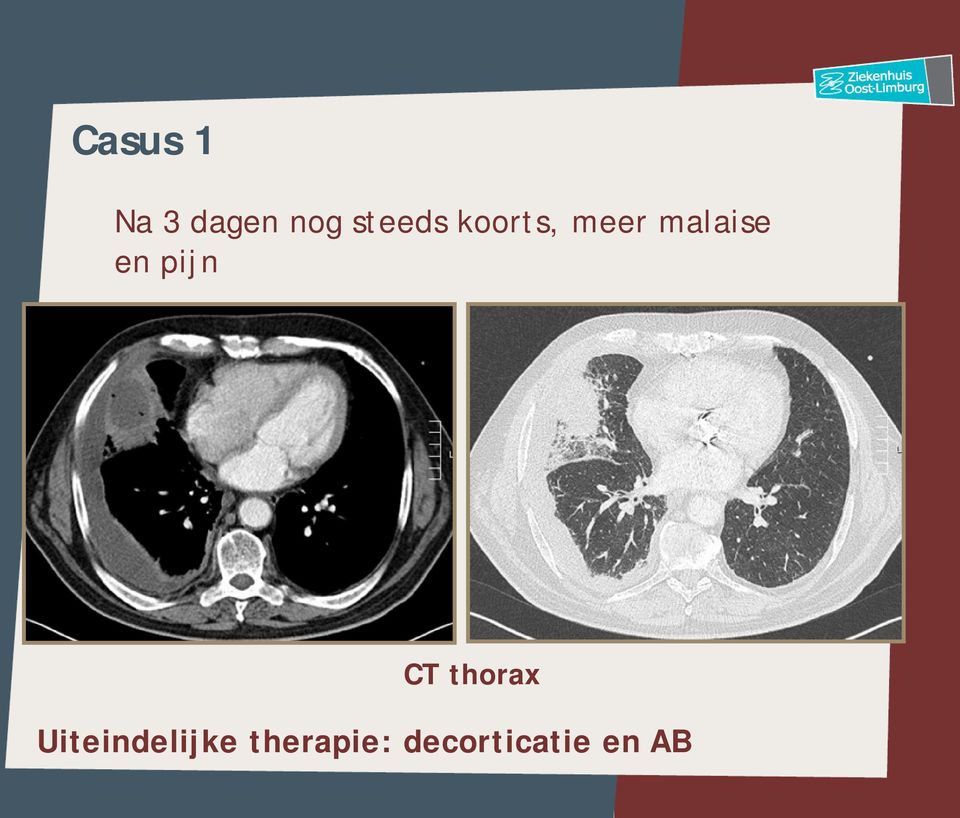 en pijn CT thorax