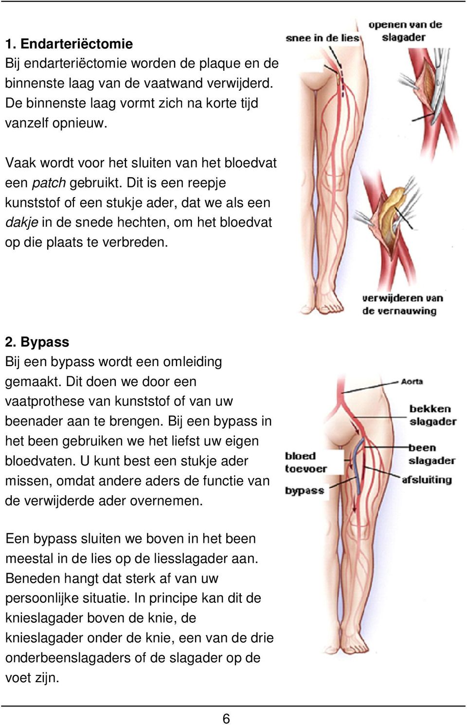 2. Bypass Bij een bypass wordt een omleiding gemaakt. Dit doen we door een vaatprothese van kunststof of van uw beenader aan te brengen.