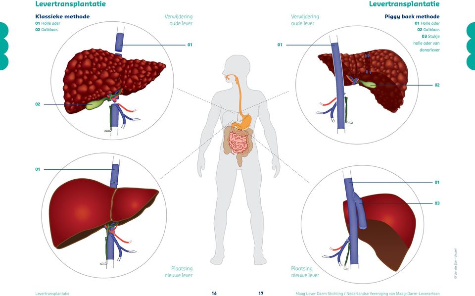 ader van 01 donorlever 02 02 01 01 Plaatsing nieuwe lever Plaatsing nieuwe lever Levertransplantatie