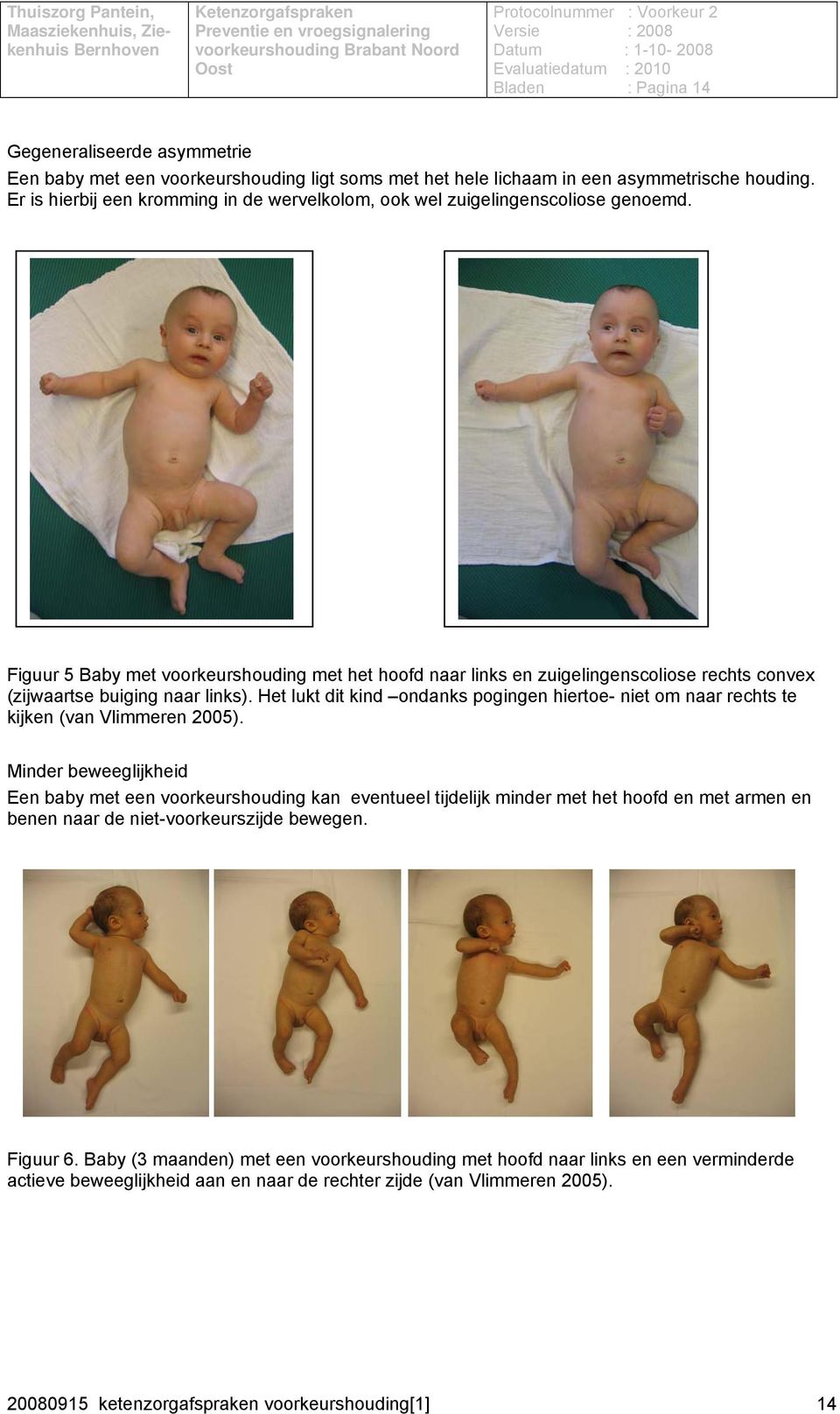 Figuur 5 Baby met voorkeurshouding met het hoofd naar links en zuigelingenscoliose rechts convex (zijwaartse buiging naar links).