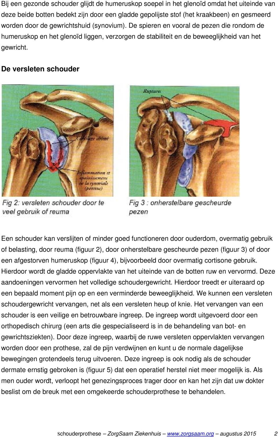 De versleten schouder Een schouder kan verslijten of minder goed functioneren door ouderdom, overmatig gebruik of belasting, door reuma (figuur 2), door onherstelbare gescheurde pezen (figuur 3) of