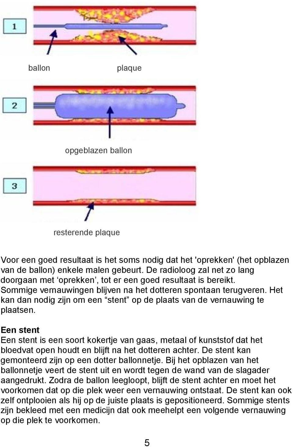 Het kan dan nodig zijn om een stent op de plaats van de vernauwing te plaatsen.