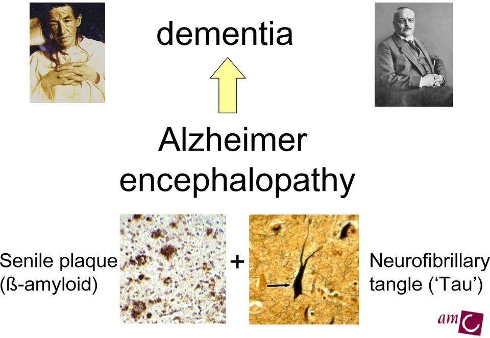 encephalopathy Senile plaque