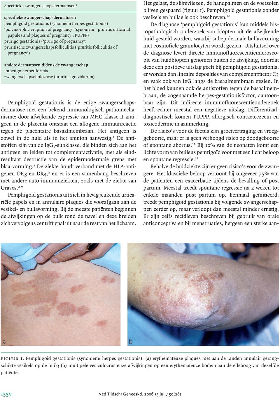 impetigo herpetiformis zwangerschapscholestase (pruritus gravidarum) Pemphigoid gestationis is de enige zwangerschapsdermatose met een bekend immunologisch pathomechanisme: door afwijkende expressie