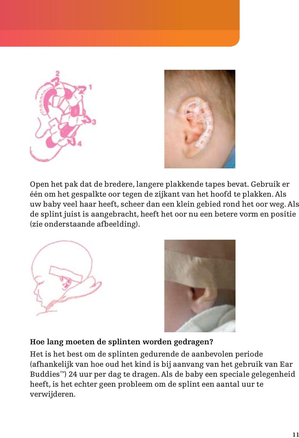 Als de splint juist is aangebracht, heeft het oor nu een betere vorm en positie (zie onderstaande afbeelding). Hoe lang moeten de splinten worden gedragen?