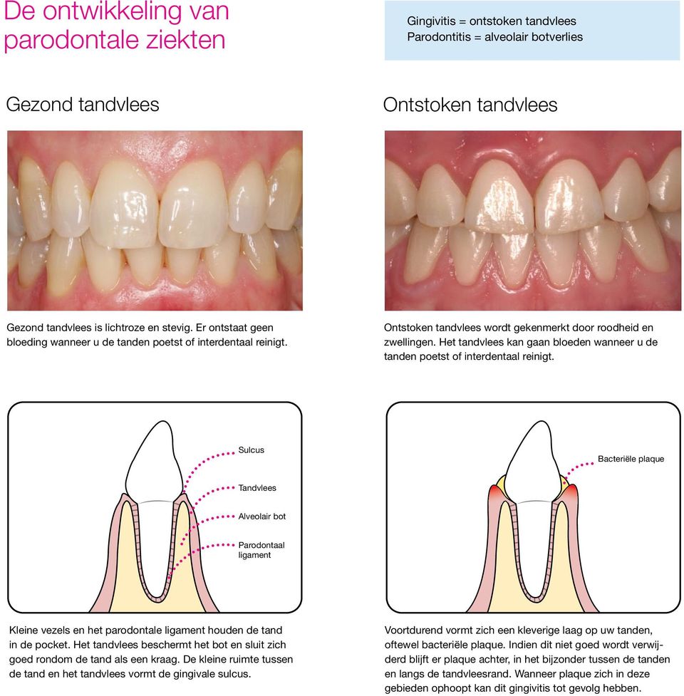 Het tandvlees kan gaan bloeden wanneer u de tanden poetst of interdentaal reinigt.