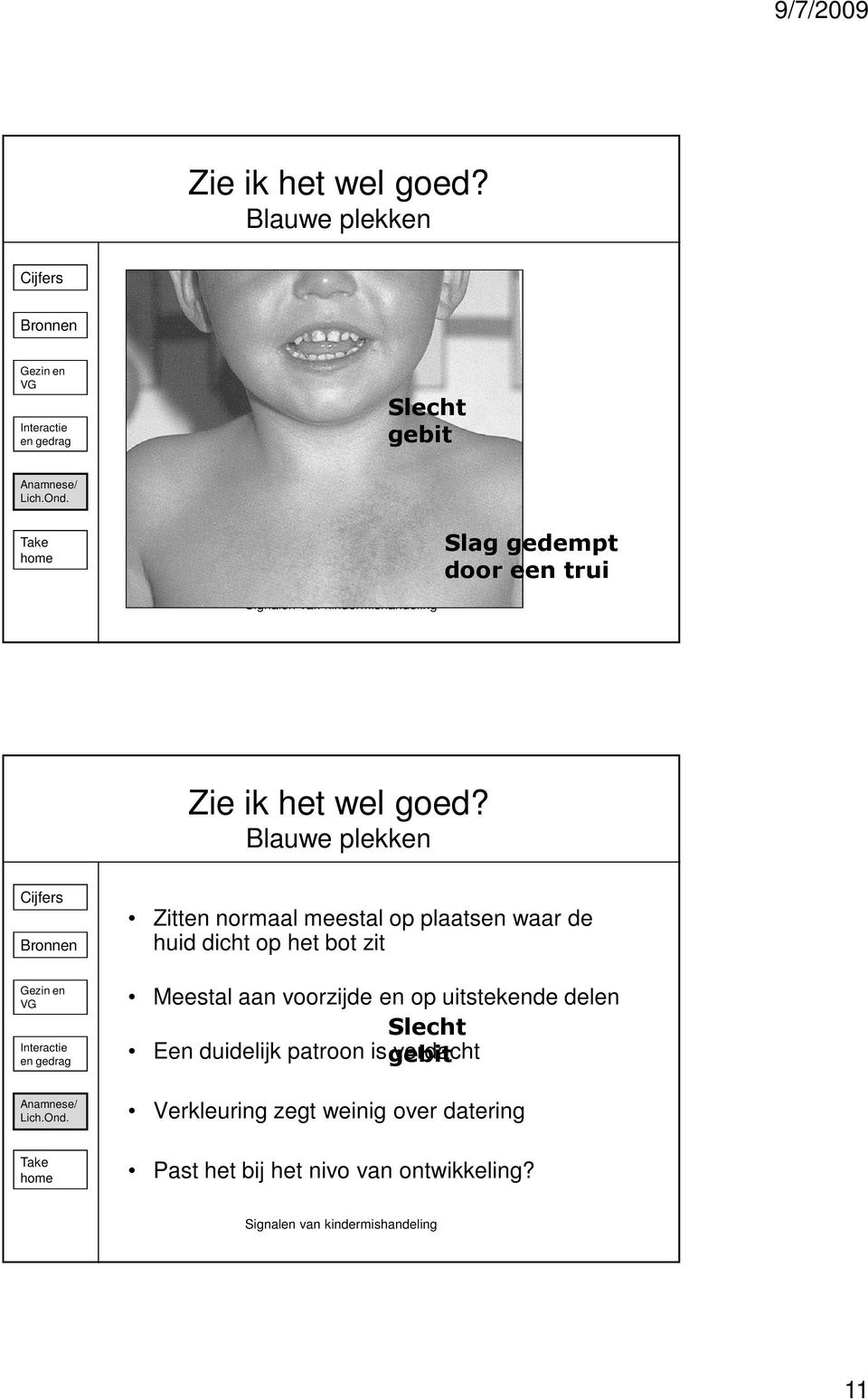 voorzijde en op uitstekende delen Slecht Een duidelijk patroon is gebit