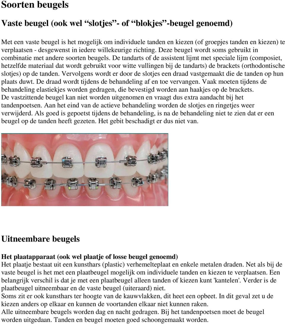 De tandarts of de assistent lijmt met speciale lijm (composiet, hetzelfde materiaal dat wordt gebruikt voor witte vullingen bij de tandarts) de brackets (orthodontische slotjes) op de tanden.