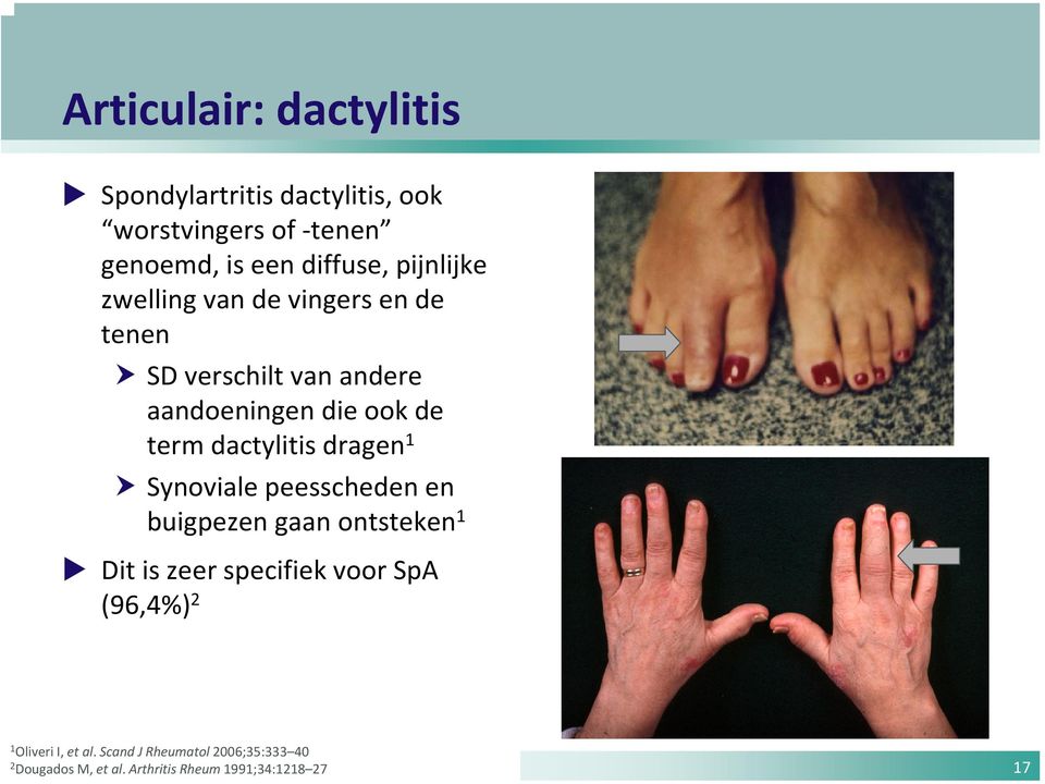 dactylitis dragen 1 Synoviale peesscheden en buigpezen gaan ontsteken 1 Dit is zeer specifiek voor SpA