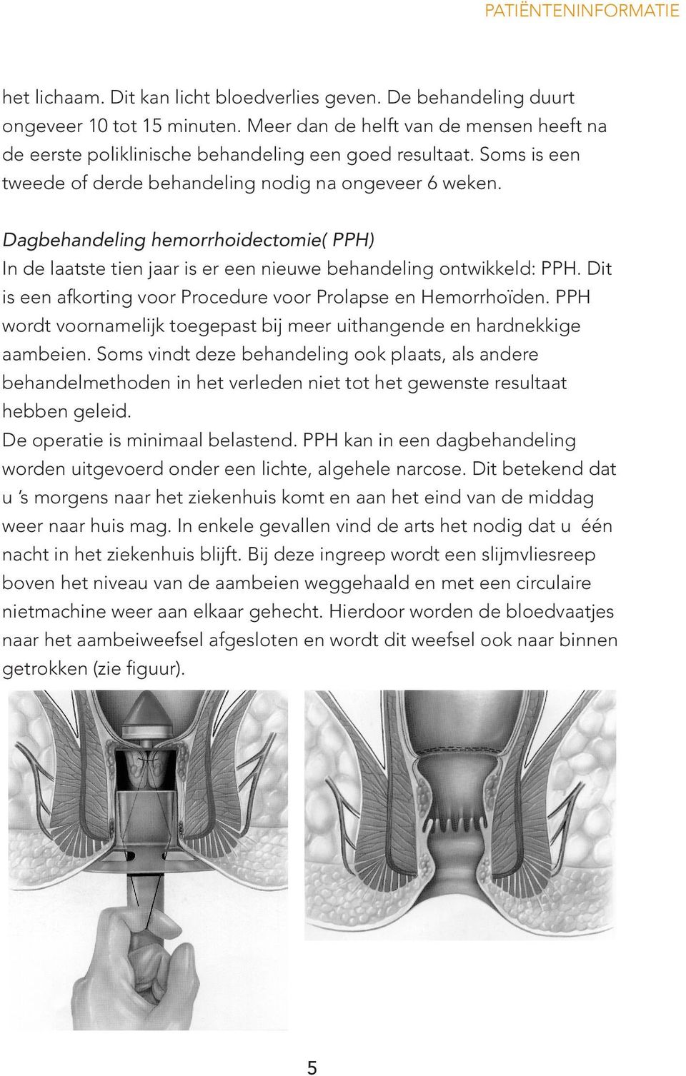 Dagbehandeling hemorrhoidectomie( PPH) In de laatste tien jaar is er een nieuwe behandeling ontwikkeld: PPH. Dit is een afkorting voor Procedure voor Prolapse en Hemorrhoïden.