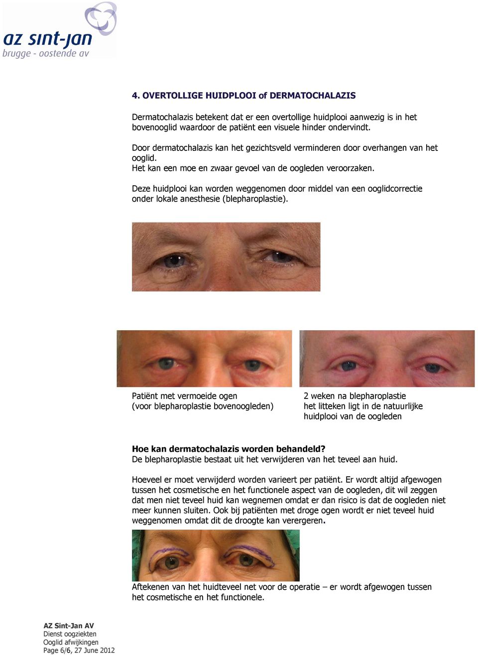 Deze huidplooi kan worden weggenomen door middel van een ooglidcorrectie onder lokale anesthesie (blepharoplastie).