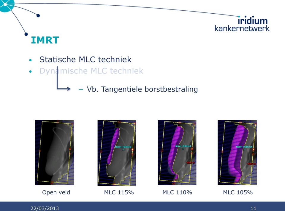 Tangentiele borstbestraling