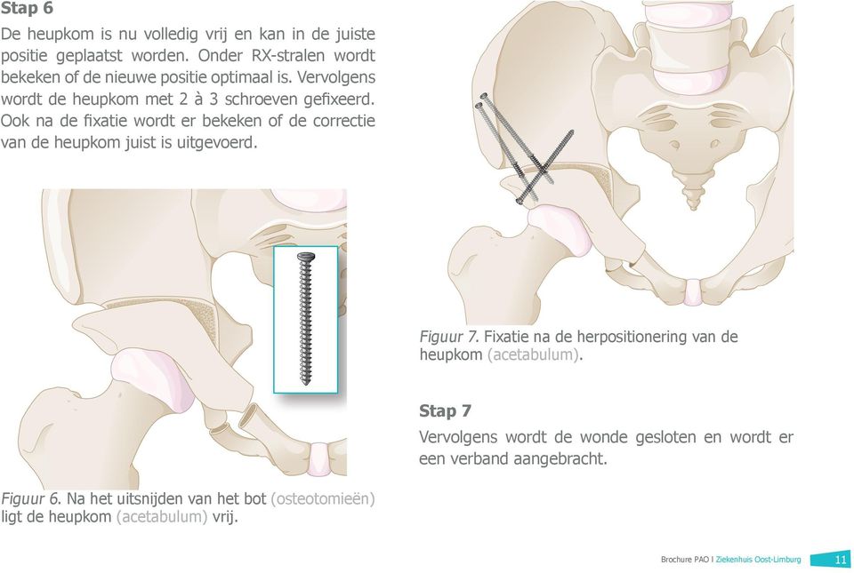 Ook na de fixatie wordt er bekeken of de correctie van de heupkom juist is uitgevoerd. Figuur 7.