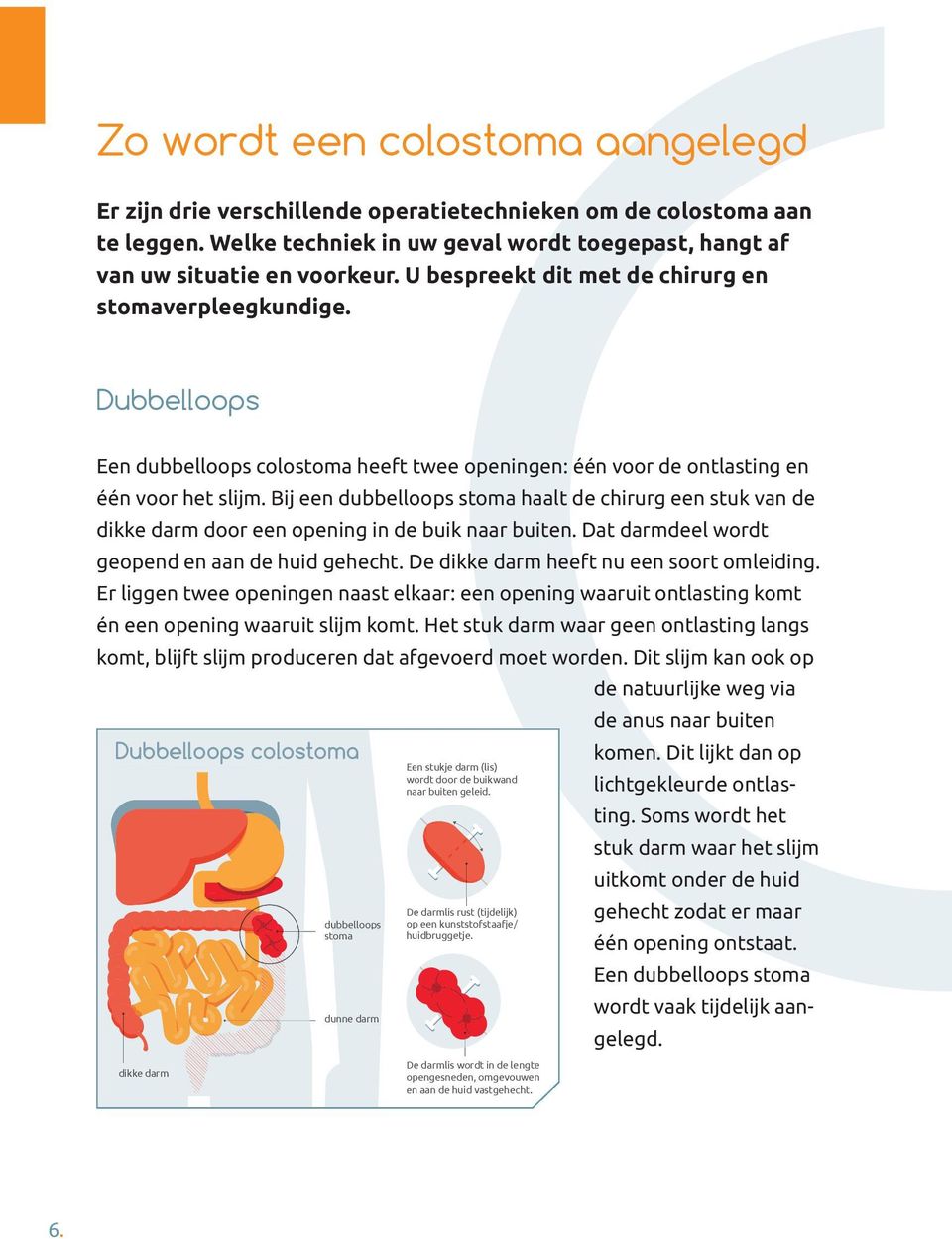 Bij een dubbelloops stoma haalt de chirurg een stuk van de dikke darm door een opening in de buik naar buiten. Dat darmdeel wordt geopend en aan de huid gehecht.