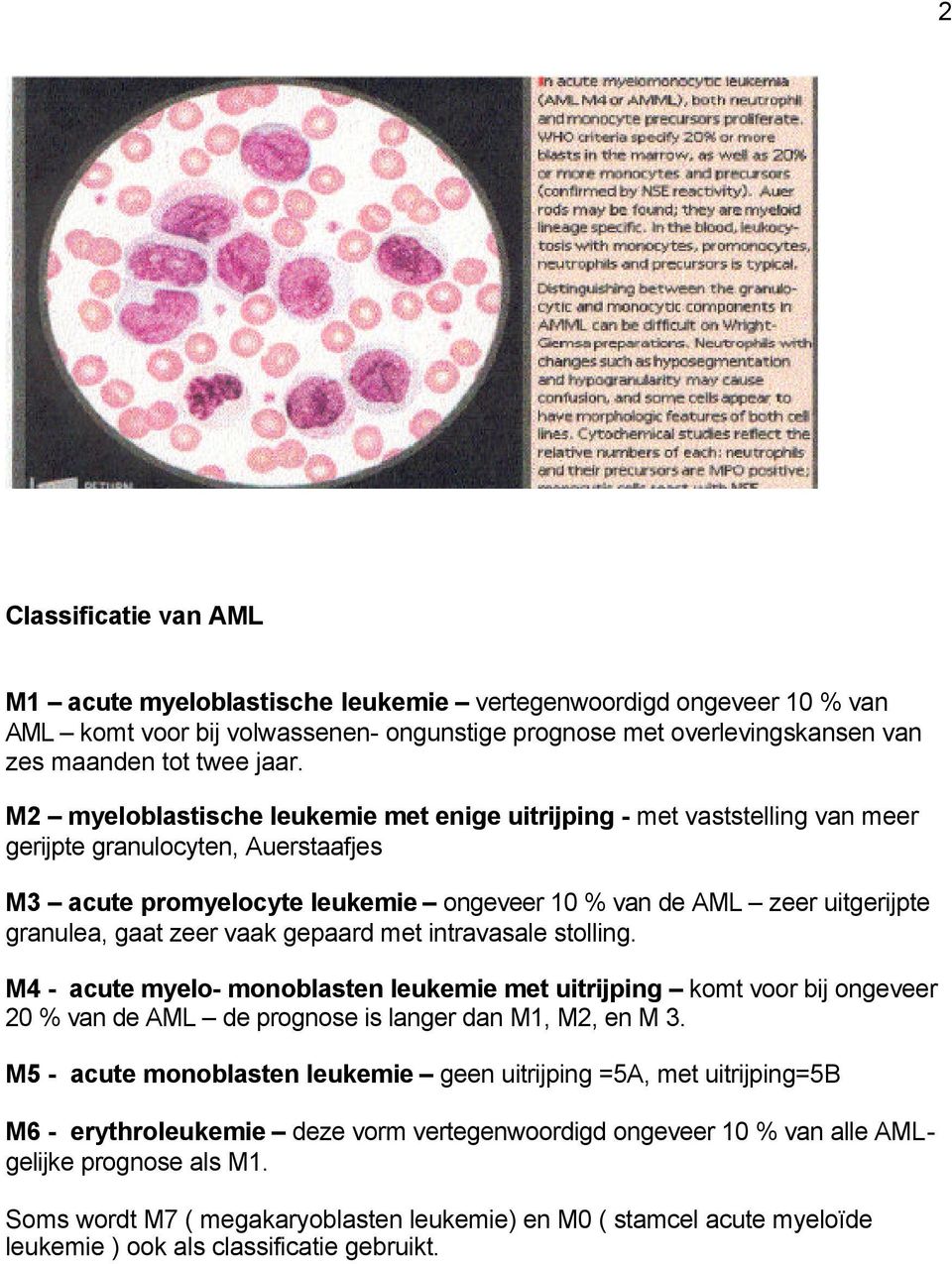 gaat zeer vaak gepaard met intravasale stolling. M4 - acute myelo- monoblasten leukemie met uitrijping komt voor bij ongeveer 20 % van de AML de prognose is langer dan M1, M2, en M 3.