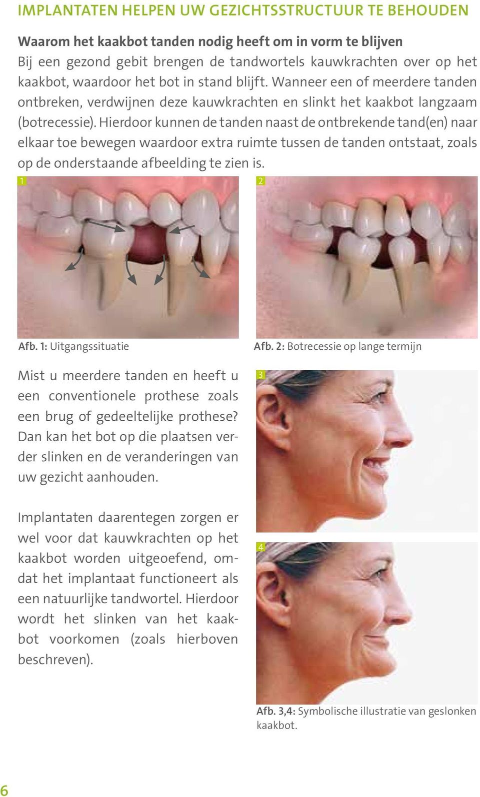 Hierdoor kunnen de tanden naast de ontbrekende tand(en) naar elkaar toe bewegen waardoor extra ruimte tussen de tanden ontstaat, zoals op de onderstaande afbeelding te zien is. 1 2 Afb.