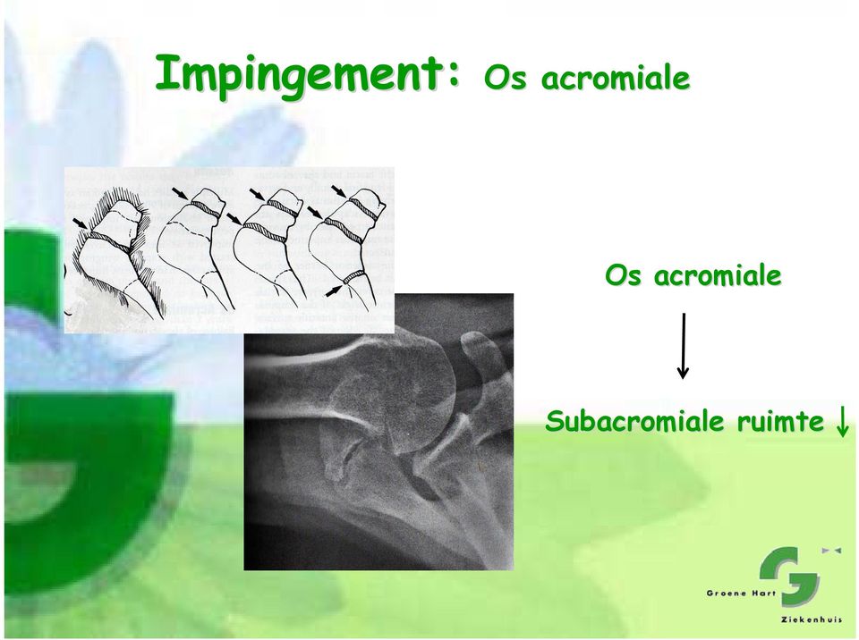 Subacromiale