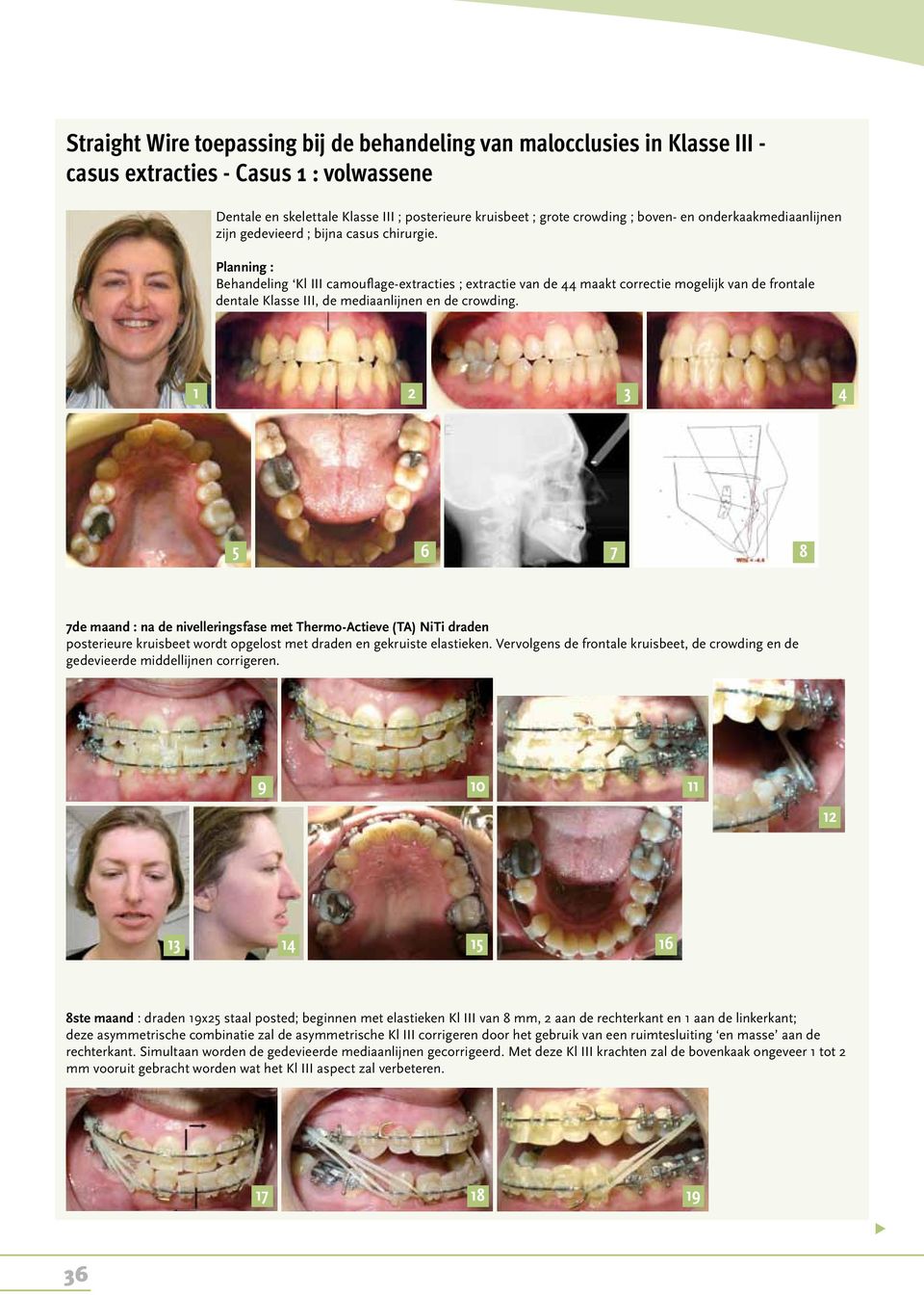 Planning : Behandeling Kl III camouflage-extracties ; extractie van de 44 maakt correctie mogelijk van de frontale dentale Klasse III, de mediaanlijnen en de crowding.