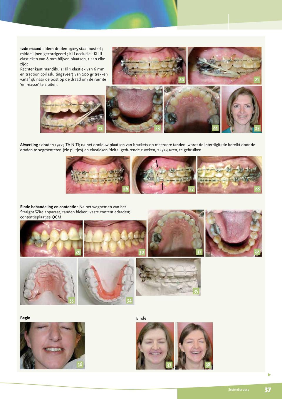 20 21 22 23 24 25 Afwerking : draden 19x25 TA NiTi; na het opnieuw plaatsen van brackets op meerdere tanden, wordt de interdigitatie bereikt door de draden te segmenteren (zie pijltjes) en