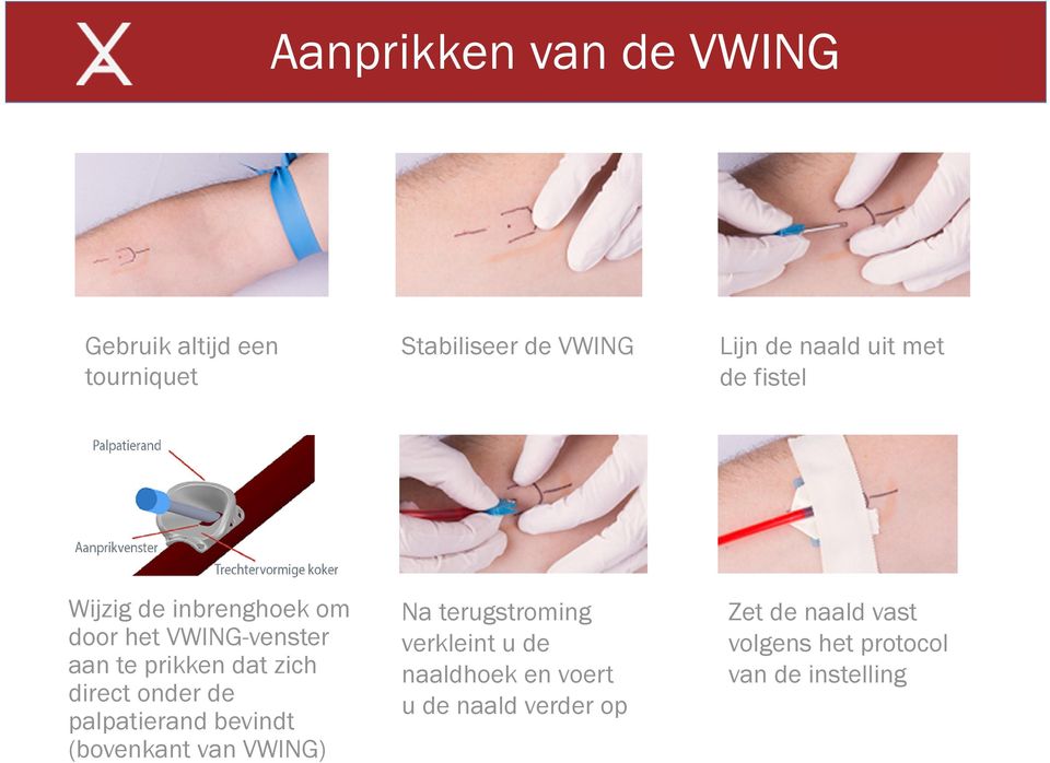 direct onder de palpatierand bevindt (bovenkant van VWING) Na terugstroming verkleint u de