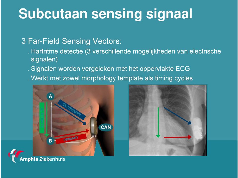 signalen). Signalen worden vergeleken met het oppervlakte ECG.