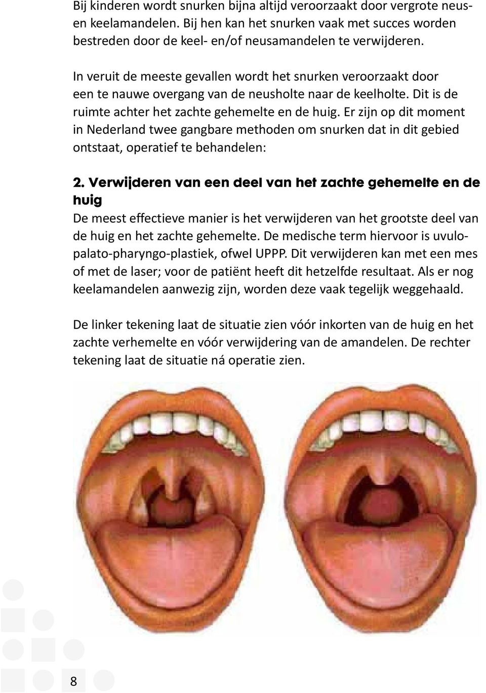 Er zijn op dit moment in Nederland twee gangbare methoden om snurken dat in dit gebied ontstaat, operatief te behandelen: 2.