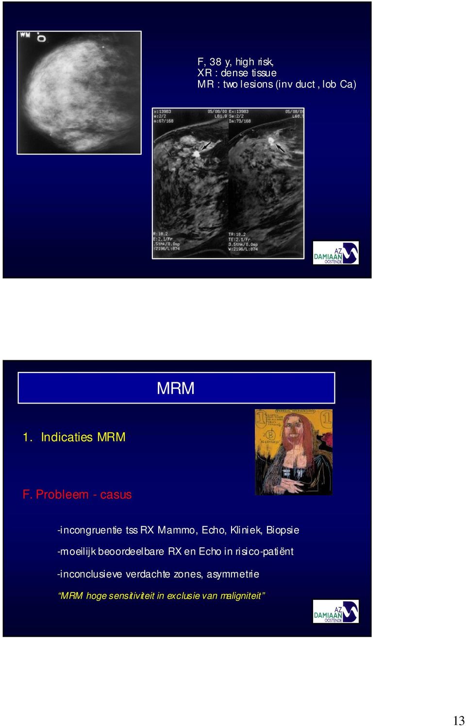 Probleem - casus -incongruentie tss RX Mammo, Echo, Kliniek, Biopsie -moeilijk