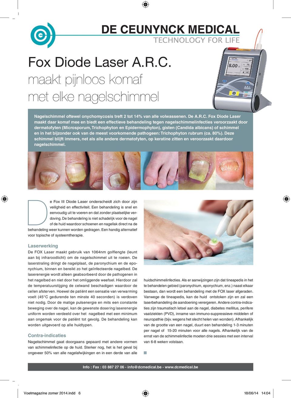 Fox Diode Laser maakt daar komaf mee en biedt een effectieve behandeling tegen nagelschimmelinfecties veroorzaakt door dermatofyten (Microsporum, Trichophyton en Epidermophyton), gisten (Candida