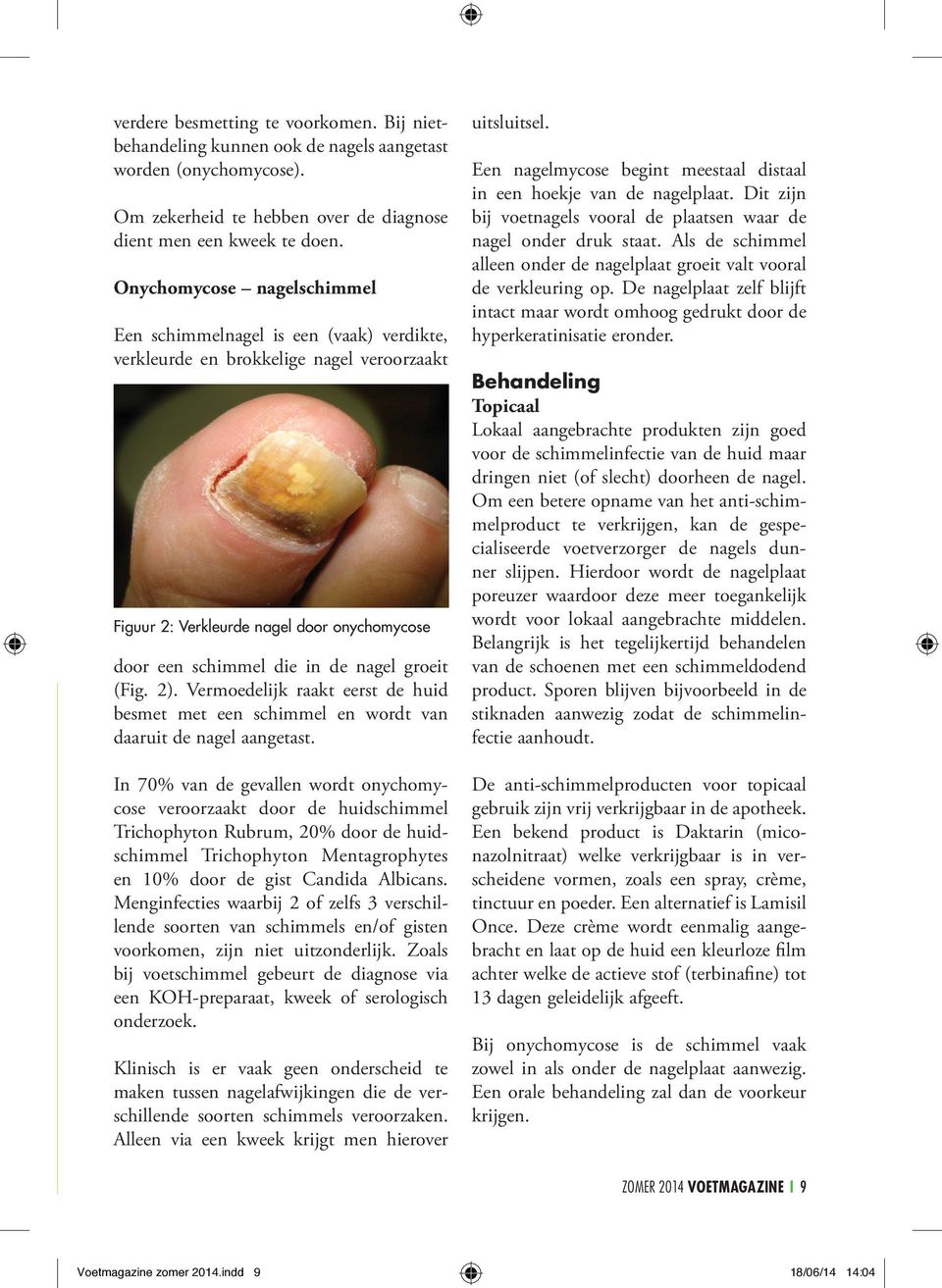 (Fig. 2). Vermoedelijk raakt eerst de huid besmet met een schimmel en wordt van daaruit de nagel aangetast.