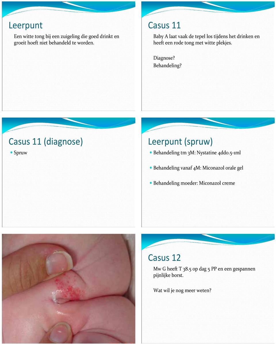 Behandeling? Casus 11 (diagnose) Spruw (spruw) Behandeling tm 3M: Nystatine 4dd0.