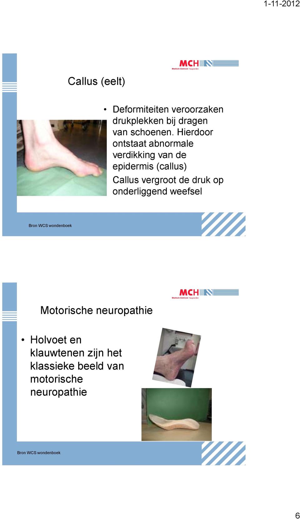 de druk op onderliggend weefsel Bron WCS wondenboek Motorische neuropathie