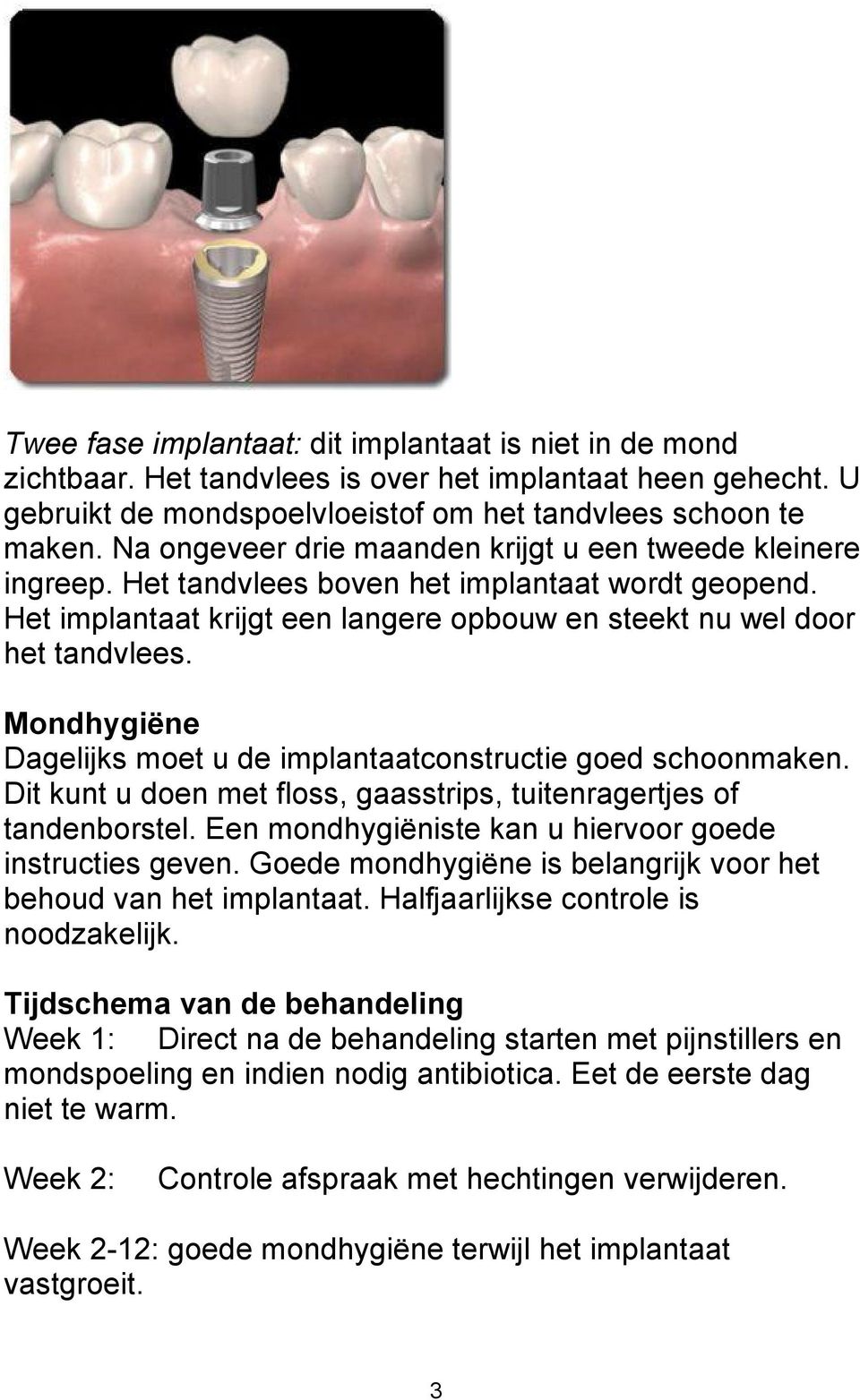 Mondhygiëne Dagelijks moet u de implantaatconstructie goed schoonmaken. Dit kunt u doen met floss, gaasstrips, tuitenragertjes of tandenborstel.