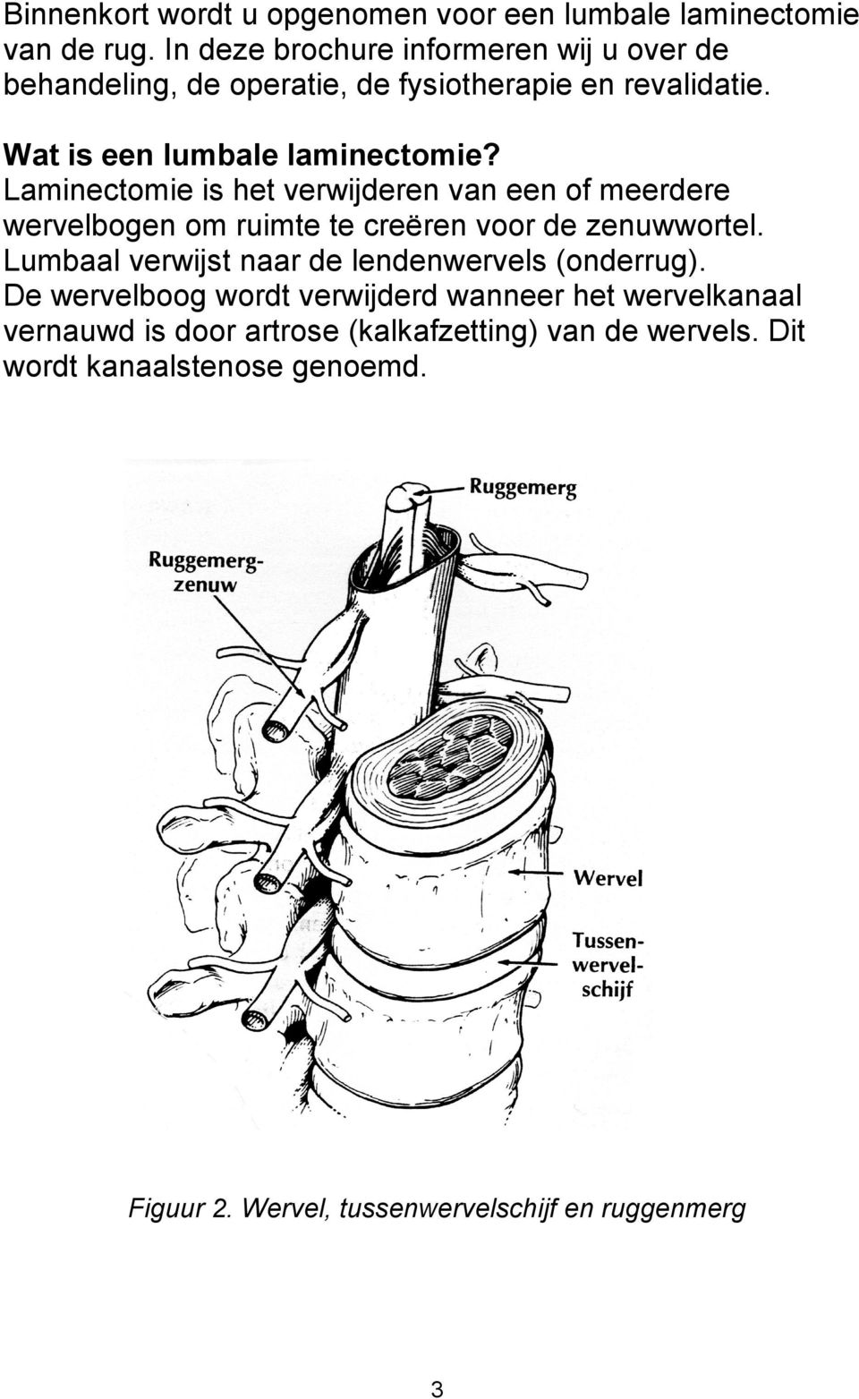 Laminectomie is het verwijderen van een of meerdere wervelbogen om ruimte te creëren voor de zenuwwortel.