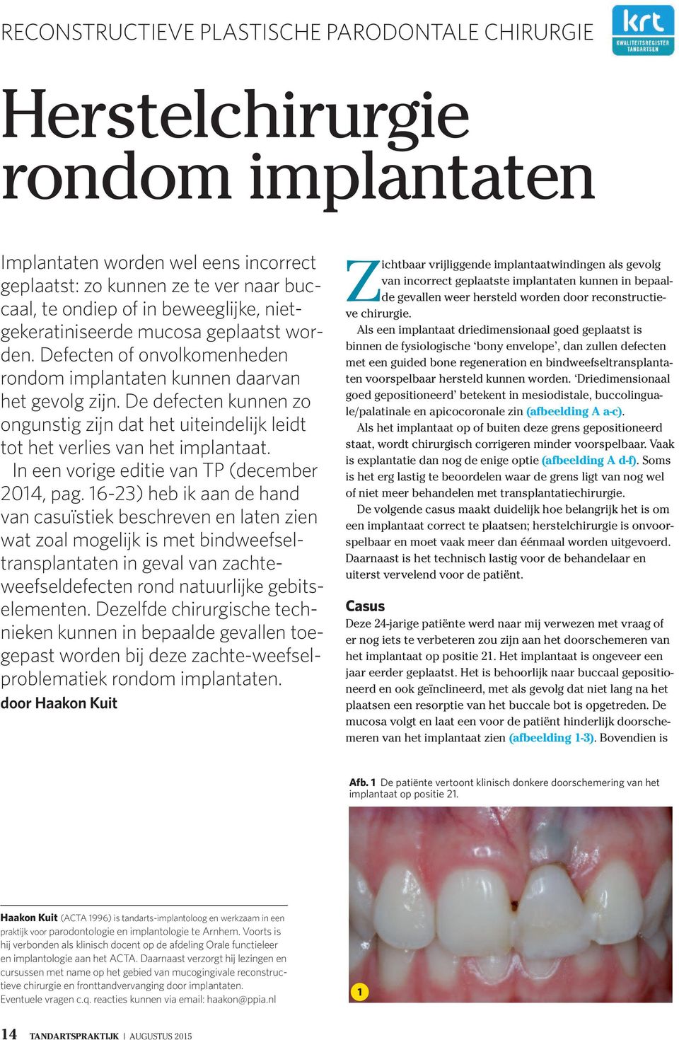 De defecten knnen zo ongnstig zijn dat het iteindelijk leidt tot het verlies van het implantaat. In een vorige editie van TP (december 2014, pag.